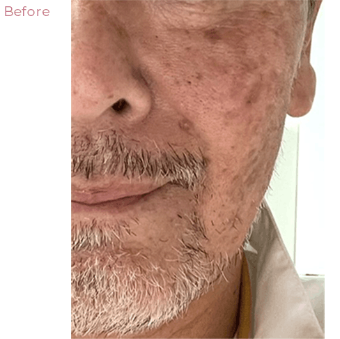 代々木上原の美容皮膚科｜シミ・シワ・毛穴・そばかす・くすみならピコレーザー導入のAK dental care