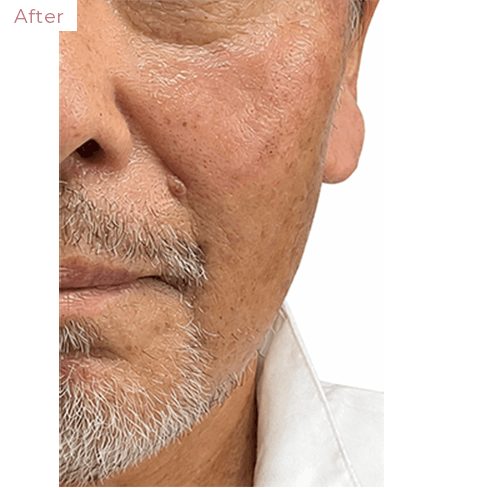 代々木上原の美容皮膚科｜シミ・シワ・毛穴・そばかす・くすみならピコレーザー導入のAK dental care