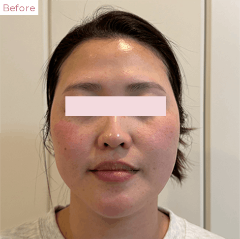 代々木上原の美容皮膚科｜シミ・シワ・毛穴・そばかす・くすみならピコレーザー導入のAK dental care