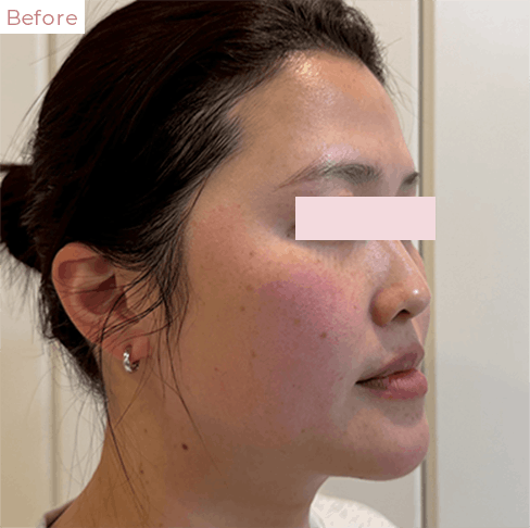 代々木上原の美容皮膚科｜シミ・シワ・毛穴・そばかす・くすみならピコレーザー導入のAK dental care