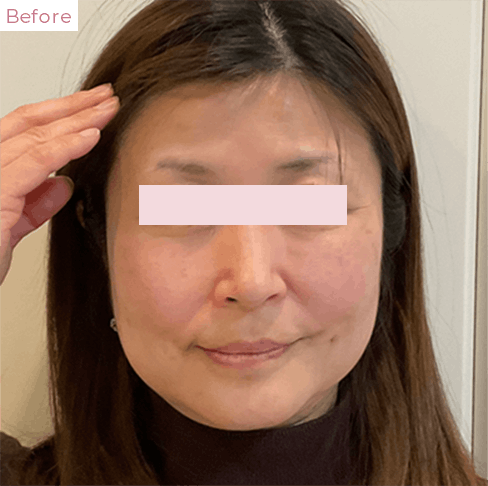 代々木上原の美容皮膚科｜シミ・シワ・毛穴・そばかす・くすみならピコレーザー導入のAK dental care