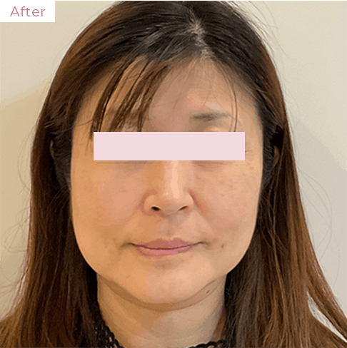 代々木上原の美容皮膚科｜シミ・シワ・毛穴・そばかす・くすみならピコレーザー導入のAK dental care