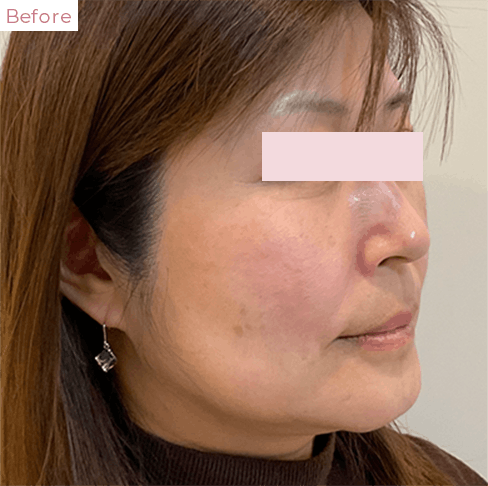 代々木上原の美容皮膚科｜シミ・シワ・毛穴・そばかす・くすみならピコレーザー導入のAK dental care