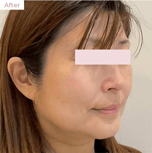 代々木上原の美容皮膚科｜シミ・シワ・毛穴・そばかす・くすみならピコレーザー導入のAK dental care