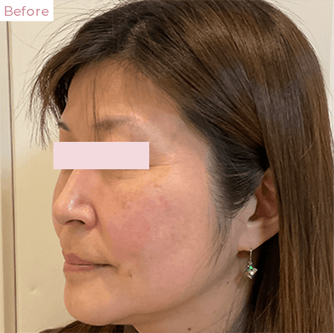 代々木上原の美容皮膚科｜シミ・シワ・毛穴・そばかす・くすみならピコレーザー導入のAK dental care