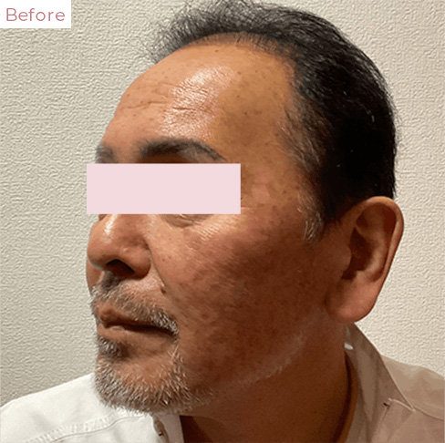 代々木上原の美容皮膚科｜シミ・シワ・毛穴・そばかす・くすみならピコレーザー導入のAK dental care