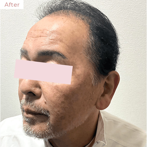 代々木上原の美容皮膚科｜シミ・シワ・毛穴・そばかす・くすみならピコレーザー導入のAK dental care