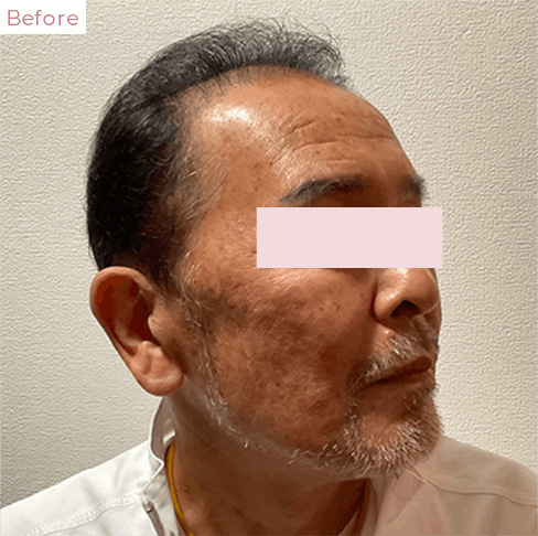 代々木上原の美容皮膚科｜シミ・シワ・毛穴・そばかす・くすみならピコレーザー導入のAK dental care