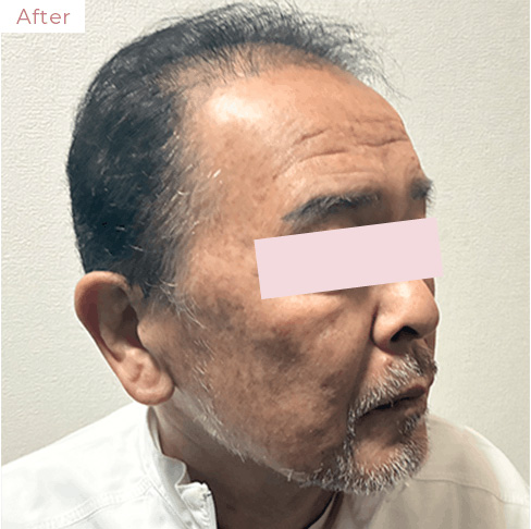 代々木上原の美容皮膚科｜シミ・シワ・毛穴・そばかす・くすみならピコレーザー導入のAK dental care