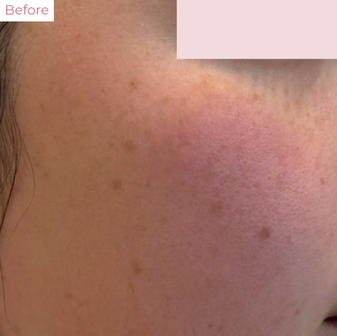 AT_20260323_01 - 代々木上原の美容皮膚科AK dental care 代々木上原の美容皮膚科|シミ・シワ・毛穴・そばかす・くすみならピコレーザー導入のAK dental care