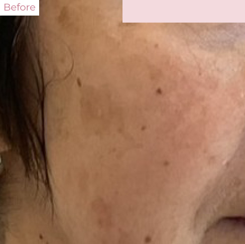 代々木上原の美容皮膚科｜シミ・シワ・毛穴・そばかす・くすみならピコレーザー導入のAK dental care