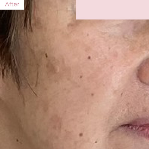 代々木上原の美容皮膚科｜シミ・シワ・毛穴・そばかす・くすみならピコレーザー導入のAK dental care