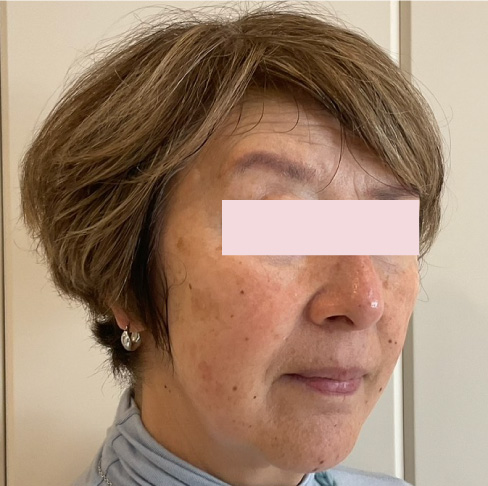 代々木上原の美容皮膚科｜シミ・シワ・毛穴・そばかす・くすみならピコレーザー導入のAK dental care