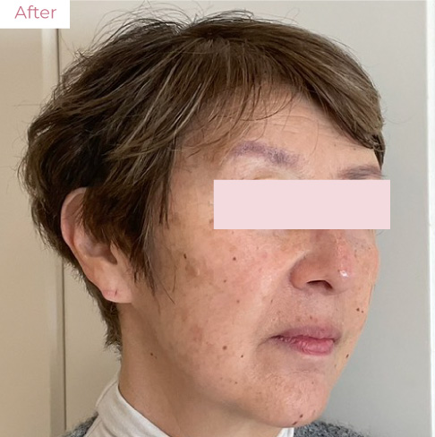 代々木上原の美容皮膚科｜シミ・シワ・毛穴・そばかす・くすみならピコレーザー導入のAK dental care