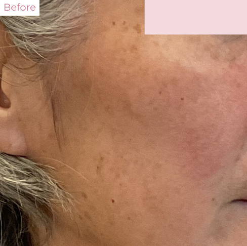 代々木上原の美容皮膚科｜シミ・シワ・毛穴・そばかす・くすみならピコレーザー導入のAK dental care