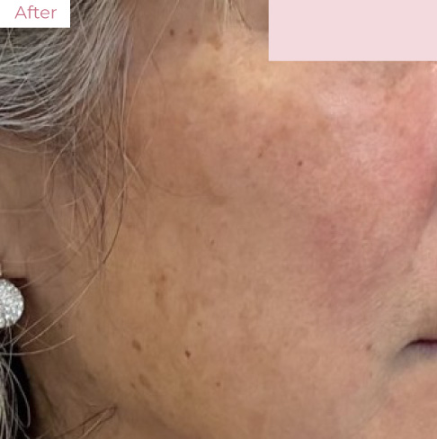 代々木上原の美容皮膚科｜シミ・シワ・毛穴・そばかす・くすみならピコレーザー導入のAK dental care