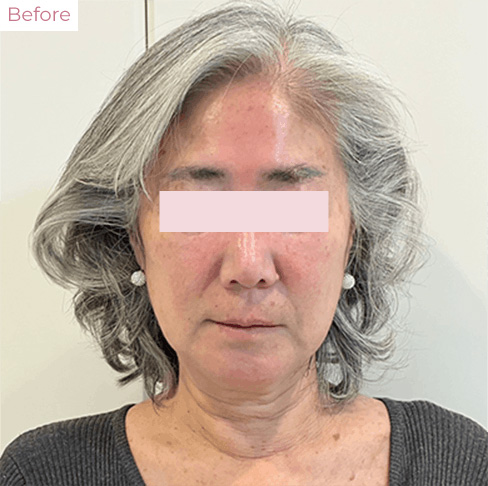 代々木上原の美容皮膚科｜シミ・シワ・毛穴・そばかす・くすみならピコレーザー導入のAK dental care