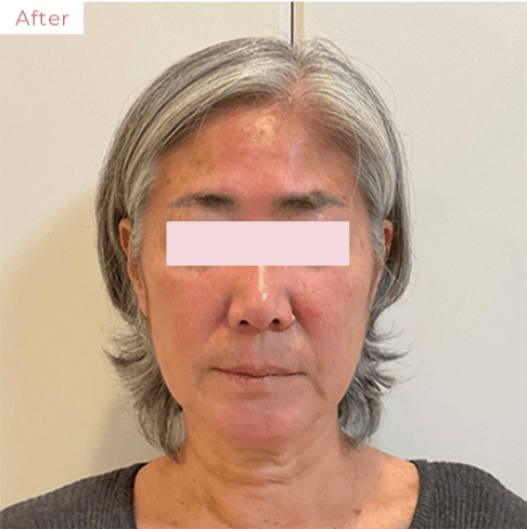 代々木上原の美容皮膚科｜シミ・シワ・毛穴・そばかす・くすみならピコレーザー導入のAK dental care