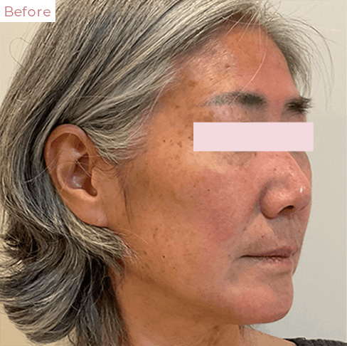 代々木上原の美容皮膚科｜シミ・シワ・毛穴・そばかす・くすみならピコレーザー導入のAK dental care