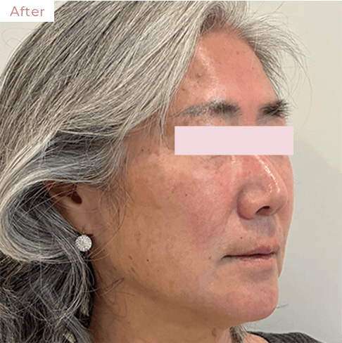 代々木上原の美容皮膚科｜シミ・シワ・毛穴・そばかす・くすみならピコレーザー導入のAK dental care