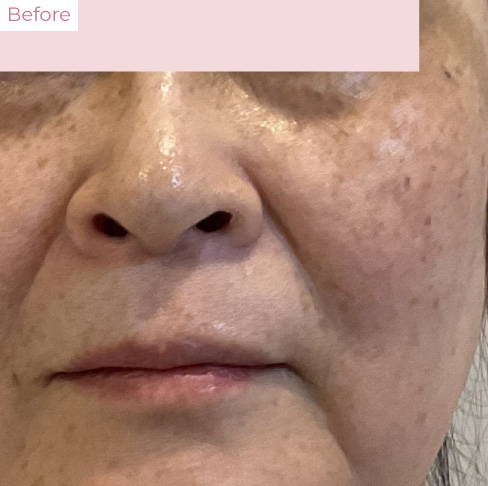 YY_20260323_01 - 代々木上原の美容皮膚科AK dental care 代々木上原の美容皮膚科|シミ・シワ・毛穴・そばかす・くすみならピコレーザー導入のAK dental care