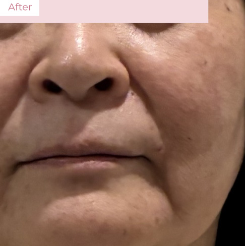 YY_20260323_02 - 代々木上原の美容皮膚科AK dental care 代々木上原の美容皮膚科|シミ・シワ・毛穴・そばかす・くすみならピコレーザー導入のAK dental care