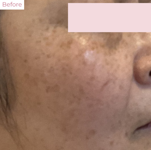 YY_20260323_03 - 代々木上原の美容皮膚科AK dental care 代々木上原の美容皮膚科|シミ・シワ・毛穴・そばかす・くすみならピコレーザー導入のAK dental care