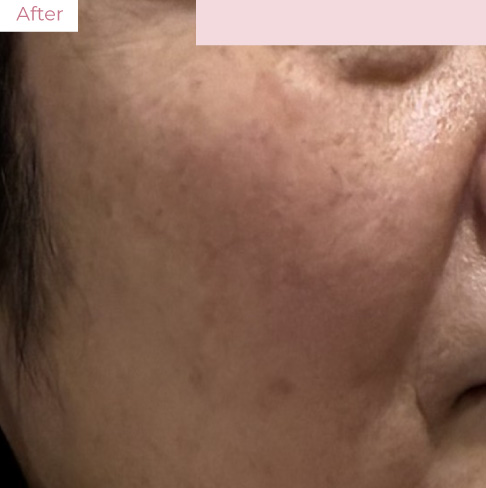 YY_20260323_04 - 代々木上原の美容皮膚科AK dental care 代々木上原の美容皮膚科|シミ・シワ・毛穴・そばかす・くすみならピコレーザー導入のAK dental care