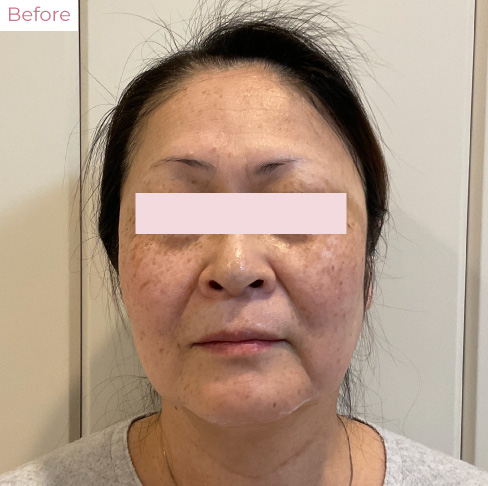 代々木上原の美容皮膚科｜シミ・シワ・毛穴・そばかす・くすみならピコレーザー導入のAK dental care