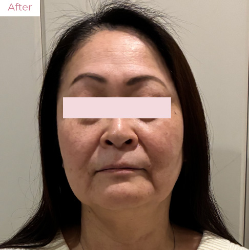 代々木上原の美容皮膚科｜シミ・シワ・毛穴・そばかす・くすみならピコレーザー導入のAK dental care