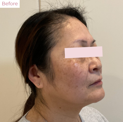 代々木上原の美容皮膚科｜シミ・シワ・毛穴・そばかす・くすみならピコレーザー導入のAK dental care