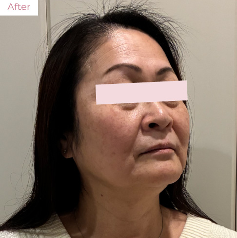 代々木上原の美容皮膚科｜シミ・シワ・毛穴・そばかす・くすみならピコレーザー導入のAK dental care